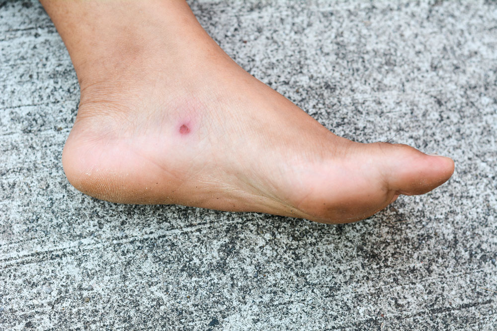 huntsville wound care treatments