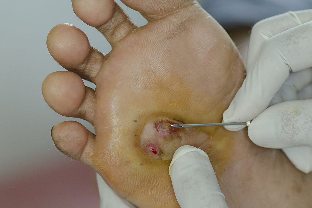 foot wound treatment near me